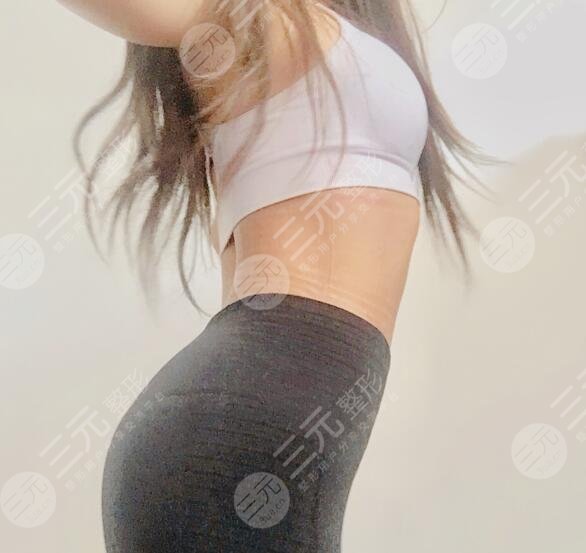 欧洲之星火凤凰纤体溶脂塑形案例后37天