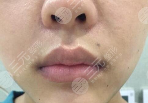 厚唇改薄整形手术图片