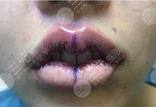 厚唇改薄整形手术图片