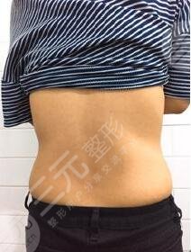 　　北京李联医疗美容诊所  　　北京李联医疗美容诊所是一家专业的形体雕塑整形机构，机构中拥有了**的设备，还有首屈一指的专家，专业的LZ网状平体雕塑。现在李联医疗美容诊所一直坚持着形体美、心里美的核心理念发展，医院将的体型雕塑专家为首，其中还有其他领域的专家，艺术精湛，为求美者的没问题做保障，已经获得了行业中更多人的喜欢。  　　医院简介  　　该院拥有了完善的技术体系，还有相关的服务体系，现在李联院长已经独创了一项综合形体雕塑的技术，该技术综合了健康的吸脂方法，并且将艺术**的融合在一起，现在针对各种的体型肥胖，还有产后的身材恢复等等都有很好的改变方法，现在医院的没问题系统也较为完善，并且吸脂后的果清晰可见，并且较为**。  　　医院也已经引进了很多专业的吸脂设备，并且拥有了国内的一些mz技术，就在同时，我衷心还有无尘、无菌的手术操作系统，为手术的没问题提供了没问题有力的保障。现在医院致力于为大家提供国际化的服务流程，从术前，就开始采用精密的检测系统，量身定制方案，之后还会让大家享受到**的术中服务，直到术后都为大家提供完善的服务。将客人作为自己的尊贵客人，提供始终如一的呵护。  　　北京李联医疗美容诊所成功吸脂案例  　　没有吸脂之前，我的腰上有很多的肉肉，都可以说是一叠一叠的了，这个要不的肉肉让我较为的苦恼，每次都在通过一些方法减掉肉肉，但是每次都面临着失败，因为多次的失败让我对于减肥失去了信心。不过后来听朋友说，吸脂就可以有的减掉肉肉。于是我来到了北京李联医疗美容诊所，在这里，我成功的瘦下来了。其实没有想到瘦下来的居然是这么简单，想想之前我的糟心减肥，再想想在北京李联医疗美容诊所不到一小时的时间我就瘦下来了，真的是不敢相信了，减肥居然是这么简单。