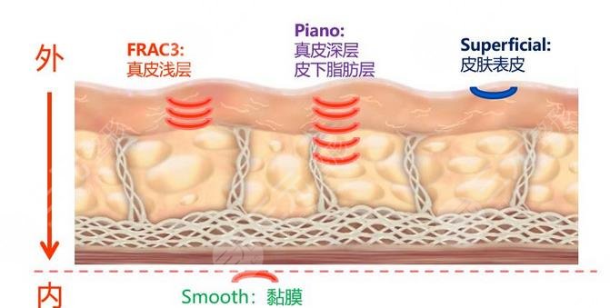 火凤凰溶脂原理