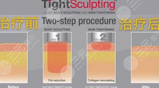 火凤凰溶脂机和冷冻哪个好