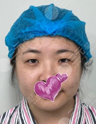 武汉协和医院割双眼皮果图