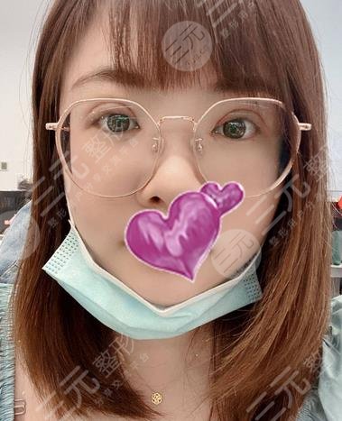 武汉协和医院割双眼皮果图