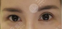 双眼皮埋线修复过程图|埋线双眼皮失败的八种图片