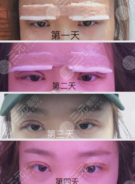 割双眼皮恢复日记