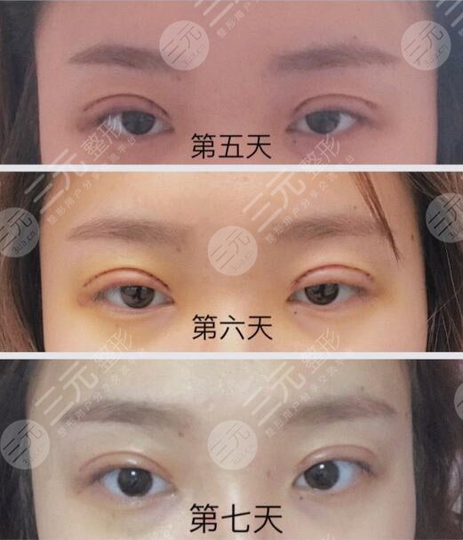 割完双眼皮一到7天图片