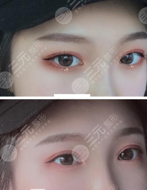 割完双眼皮3个月果图