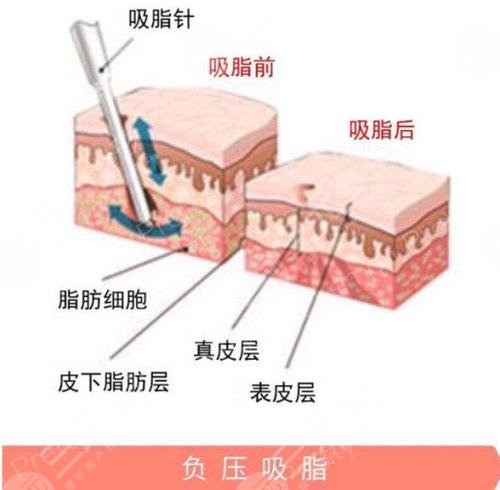 【科普】疼痛感较轻吸脂是怎么做的？吸脂手术有哪些方法呢？