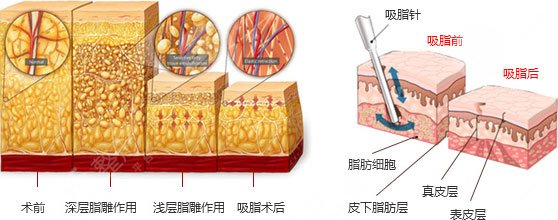 【科普】疼痛感较轻吸脂是怎么做的？吸脂手术有哪些方法呢？