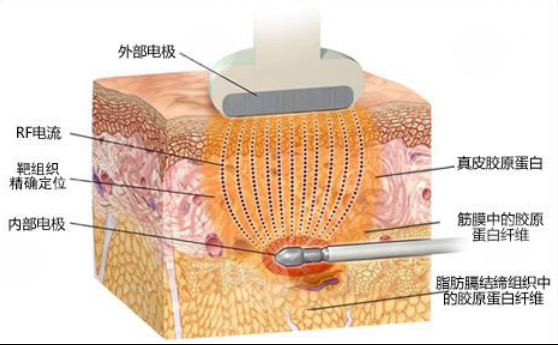 【科普】疼痛感较轻吸脂是怎么做的？吸脂手术有哪些方法呢？