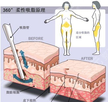 【科普】疼痛感较轻吸脂是怎么做的？吸脂手术有哪些方法呢？