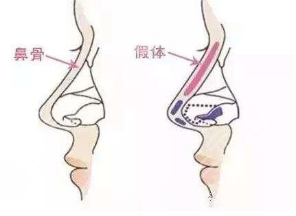 隆鼻经验