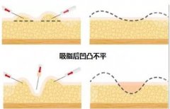 火凤凰溶脂凹凸不平是什么原因？科普干货来帮你分析！