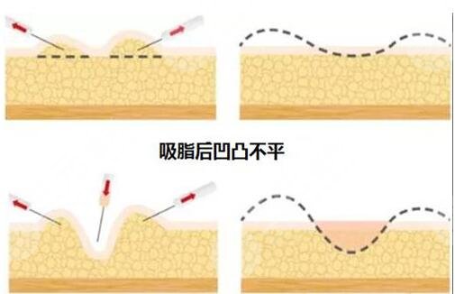 火凤凰溶脂凹凸不平是什么原因?