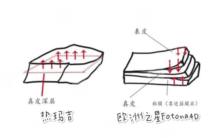 fotona激光和热玛吉的区别是什么?