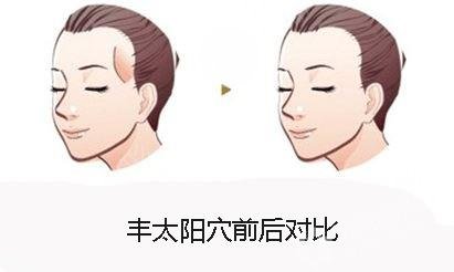 太阳穴填充果怎么样？看一下太阳填充手术后的风险果图
