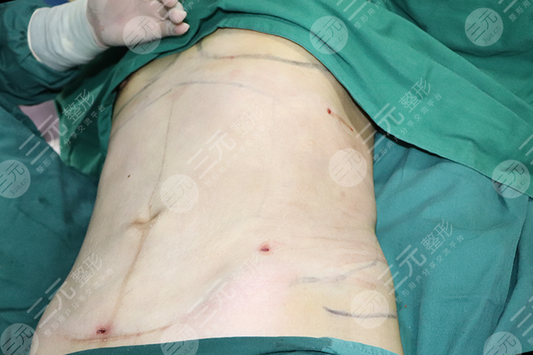 为什么腰腹吸脂后腰会变粗呢？腰腹吸脂恢复过程图来喽！