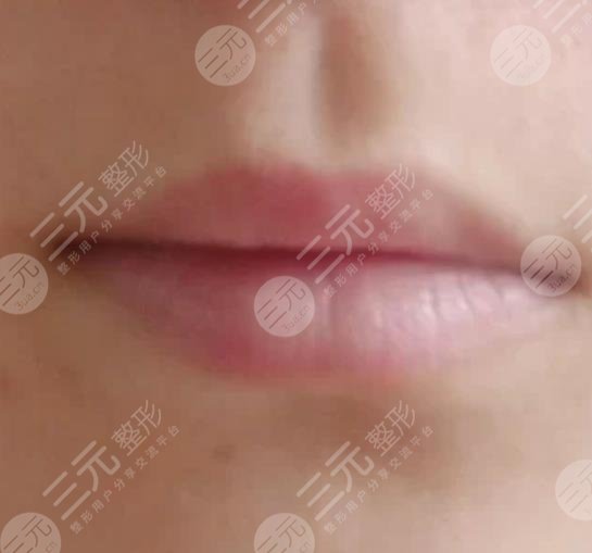 福建省立医院整形外科玻尿酸丰唇