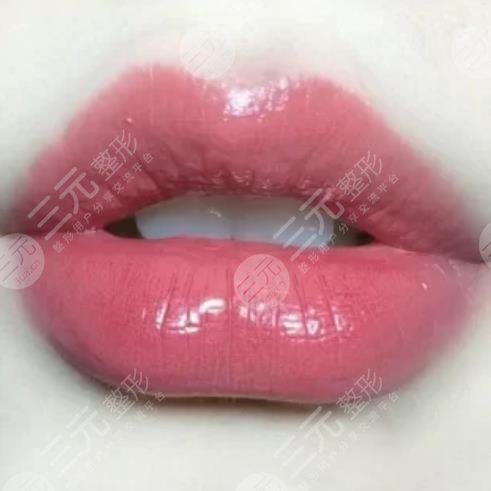 福建省立医院整形外科玻尿酸丰唇