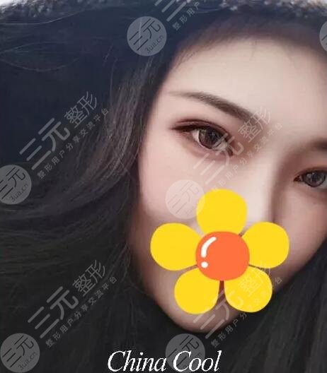 双眼皮图