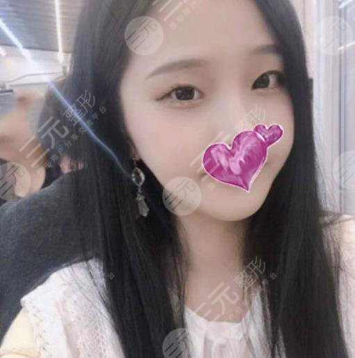 运城中心医院整形外科割双眼皮果图