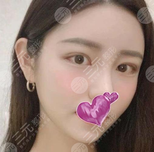 运城中心医院整形外科割双眼皮果图