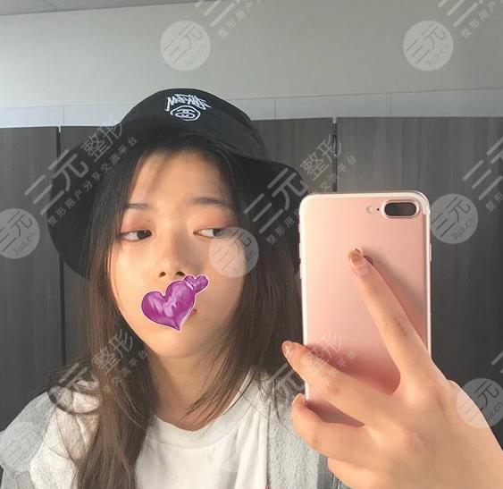 上海九院激光美容科祛斑果图