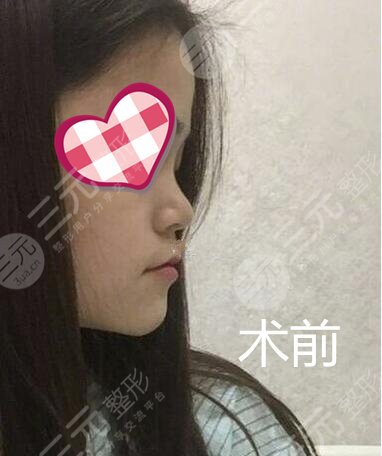 隆鼻手术果图