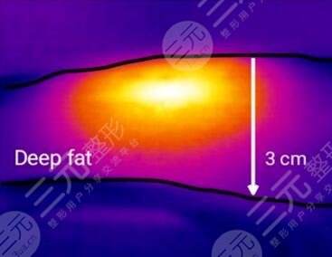 火凤凰溶脂的优势