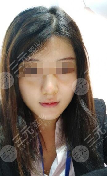 面部溶脂果后一周