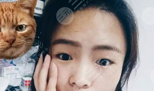 常州第一人民医院王德伟双眼皮术前