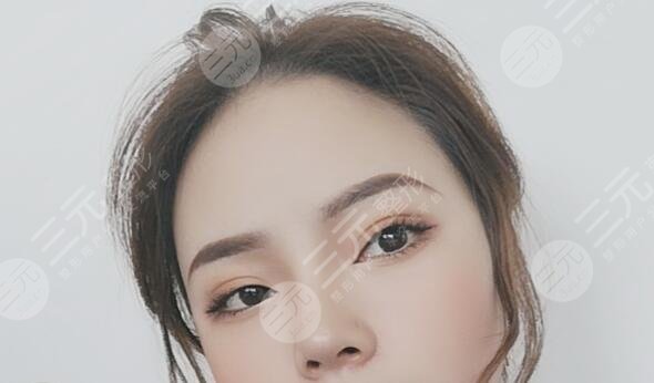 常州第一人民医院王德伟双眼皮后3周