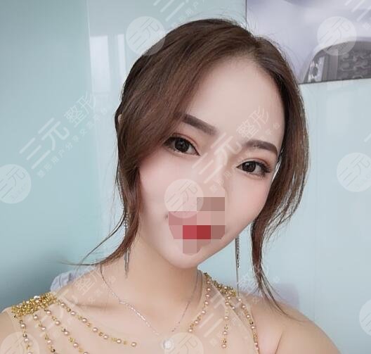 常州第一人民医院王德伟双眼皮后6周