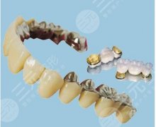 烤瓷牙寿命一般为几年？到了会怎么样？