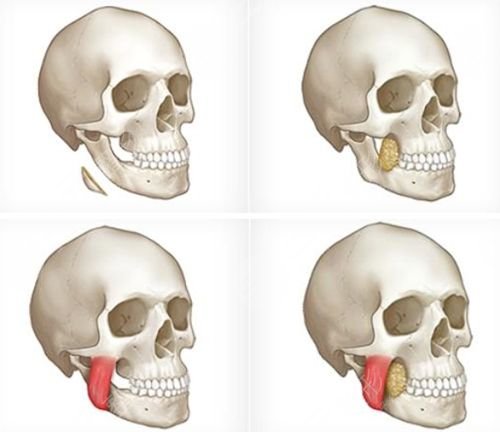 颊脂垫和咬肌位置图