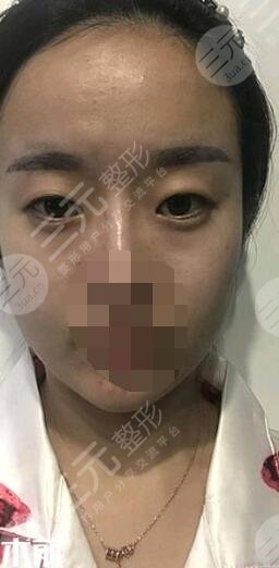 开眼角术前