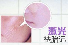 胎记缓解果—激光去胎记能报销吗？