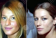 鼻头肥大怎么办？揭秘鼻头肥大矫正术多少钱？