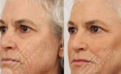 眼袋切除手术能保几年？图片|术后注意什么？