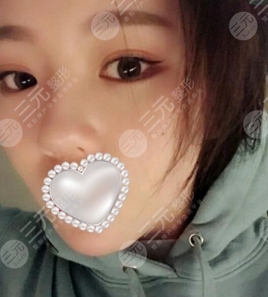fotona火凤凰溶脂双下巴果图分享去掉赘肉美丽加分