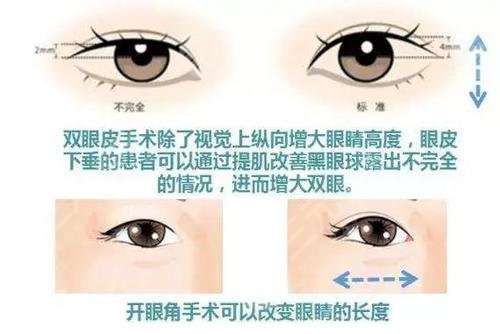 开眼角和不开眼角的原因