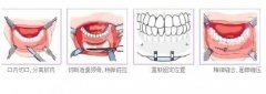 整下巴多少钱？做哪种果好？多久恢复正常呢？