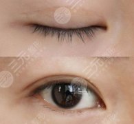 做双眼皮价格多少钱？注意哪些问题？开不开眼角？