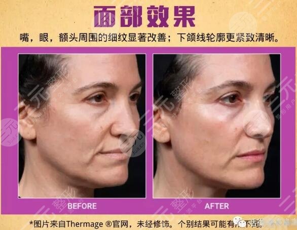 眼部热玛吉果图