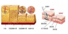 臀部吸脂15天恢复图，果大吗？有危险吗？