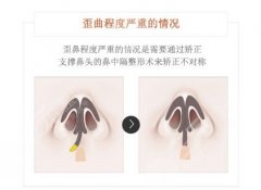 鼻子歪怎么办?鼻子歪可以埋线除皱吗? 鼻子歪怎么办?鼻子歪可以埋线除皱吗?