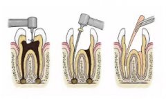 牙髓炎根管缓解费用多少？缓解过程|需要牙套吗？