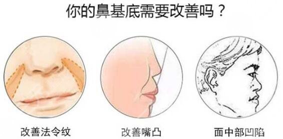 垫鼻基底手术