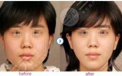 脸大注射瘦脸果好不好？注射瘦脸10天果图